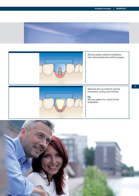 BICORTICAL® Implant with Ball Post - Implant Direct