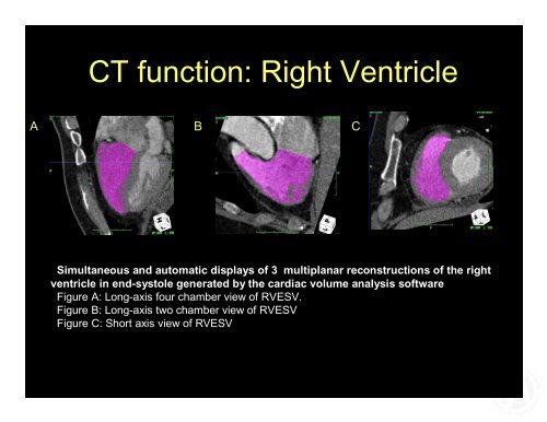 How to Report a Coronary CT Angiography Michael Poon, MD, FACC