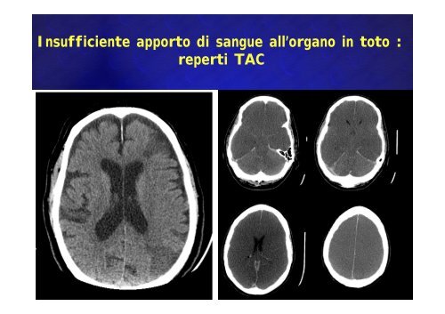 Encefalopatie anossica, ipoglicemica, diselettrolitica Encefalopatie ...