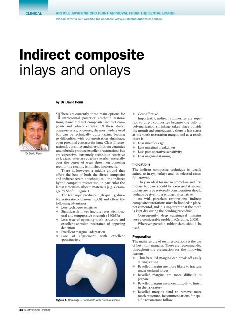 Indirect composite inlays and onlays - Southern Cross Dental ...