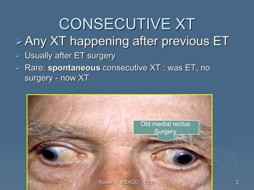 Consecutive exotropia - The Private Eye Clinic