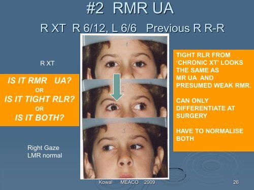 Consecutive exotropia - The Private Eye Clinic