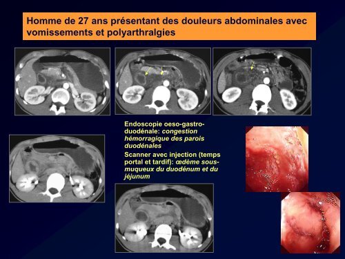 PURPURA RHUMATOIDE ET ATTEINTE DU TUBE DIGESTIF: LE ...