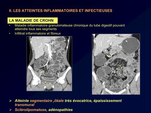 PURPURA RHUMATOIDE ET ATTEINTE DU TUBE DIGESTIF: LE ...