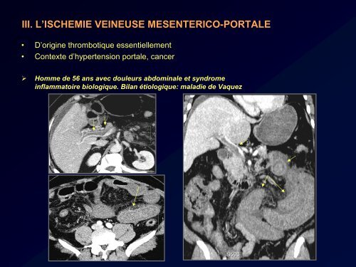 PURPURA RHUMATOIDE ET ATTEINTE DU TUBE DIGESTIF: LE ...