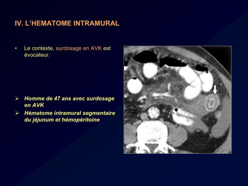 PURPURA RHUMATOIDE ET ATTEINTE DU TUBE DIGESTIF: LE ...