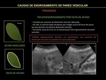 causas de engrosamiento de pared vesicular