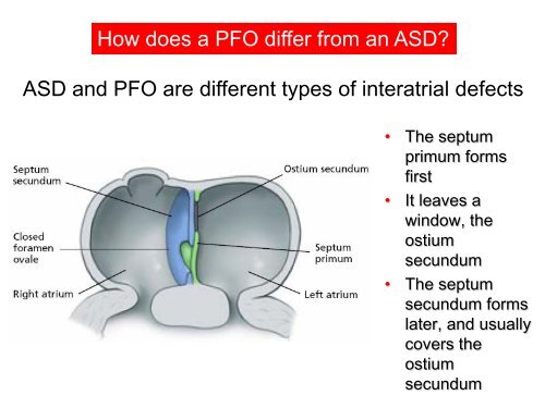 -Diagnosis of a PFO -New devices for PFO closure