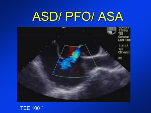 -Diagnosis of a PFO -New devices for PFO closure