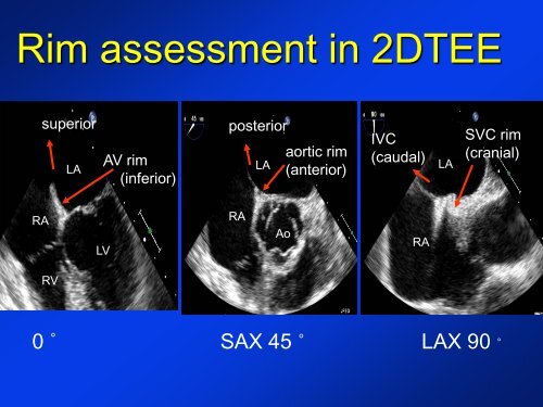 -Diagnosis of a PFO -New devices for PFO closure