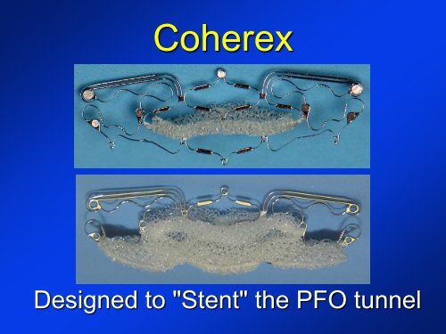 -Diagnosis of a PFO -New devices for PFO closure