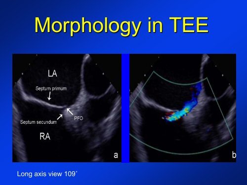 -Diagnosis of a PFO -New devices for PFO closure