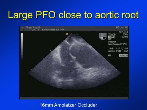 -Diagnosis of a PFO -New devices for PFO closure