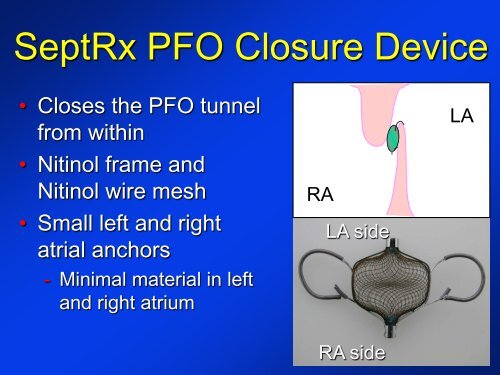 -Diagnosis of a PFO -New devices for PFO closure