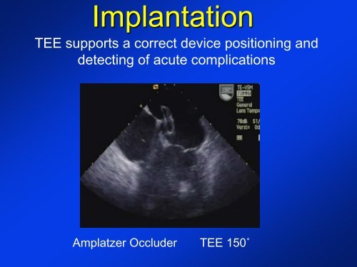 -Diagnosis of a PFO -New devices for PFO closure