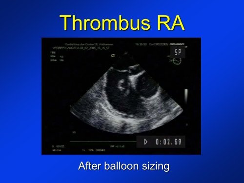 -Diagnosis of a PFO -New devices for PFO closure