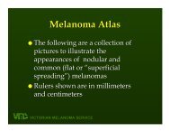 Brief information on nodular melanomas