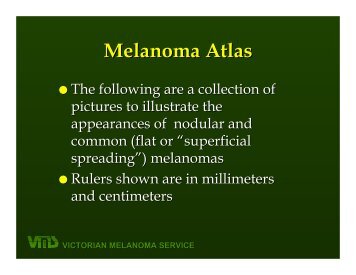 Brief information on nodular melanomas
