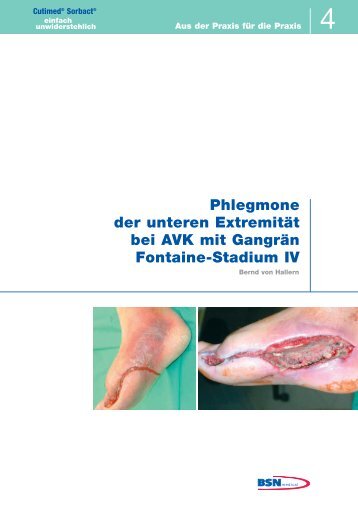 Phlegmone der unteren ExtremitÃ¤t bei AVK mit ... - Cutimed Sorbact