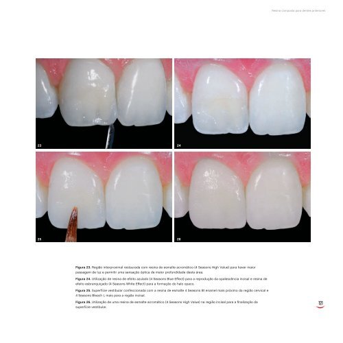 Resina composta para dentes anteriores - Kina Scopin Hirata