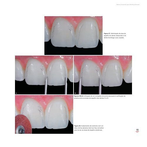 Resina composta para dentes anteriores - Kina Scopin Hirata
