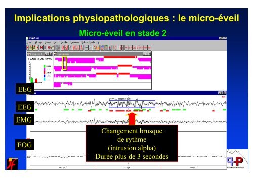 SNA et rÃ©gulation cardio-vasculaire au cours du sommeil - SPLF