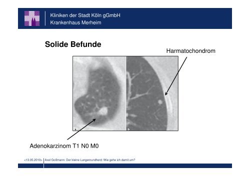 Der kleine Lungenrundherd: Wie gehe ich damit um?