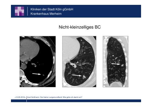 Der kleine Lungenrundherd: Wie gehe ich damit um?