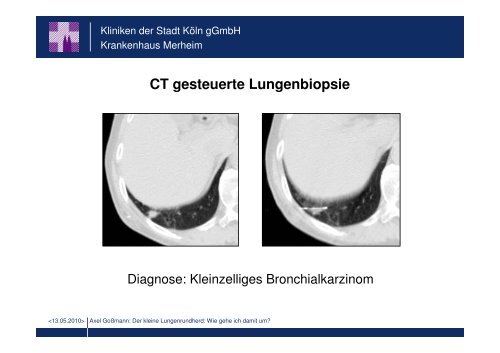 Der kleine Lungenrundherd: Wie gehe ich damit um?