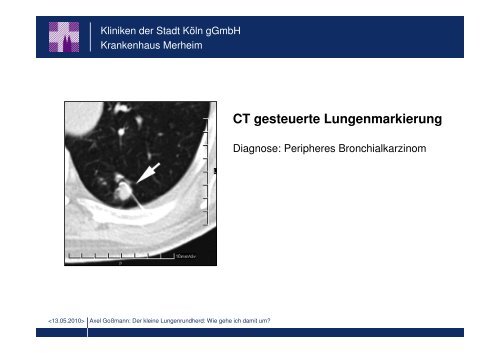 Der kleine Lungenrundherd: Wie gehe ich damit um?