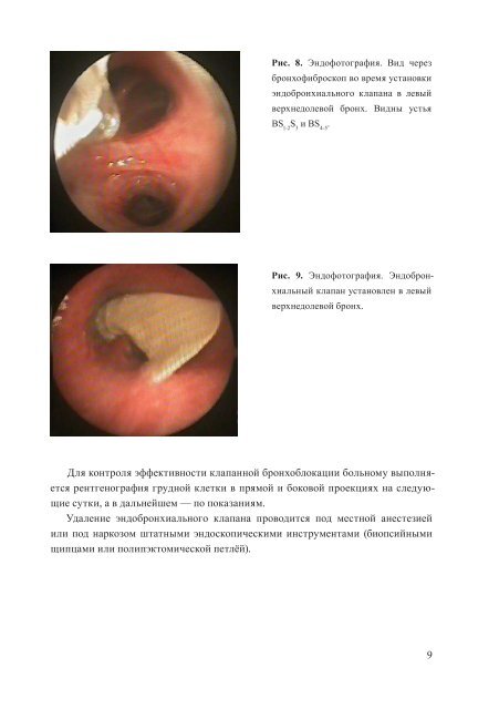 Применение клапанной бронхоблокации при ... - Medlung