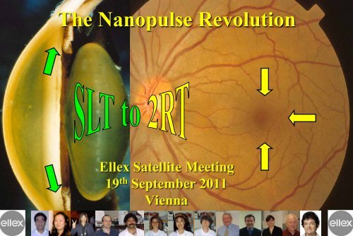 The Nanopulse Revolution - SLT for Glaucoma | Ellex