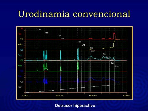 INCONTINENCIA DE ORINA