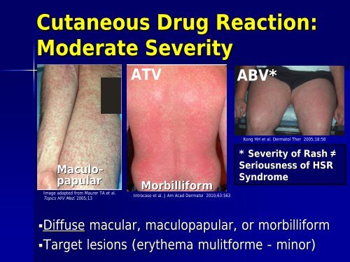 Approach to Rash in a Patient with HIV