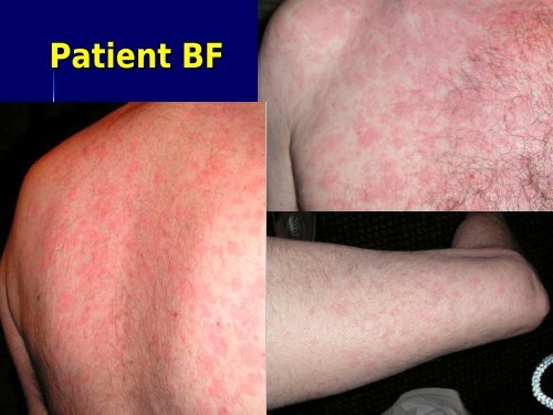 Approach to Rash in a Patient with HIV