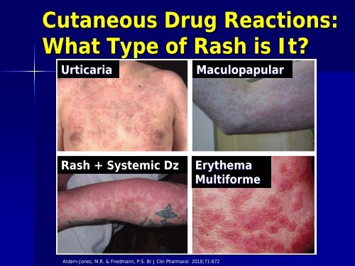 Approach to Rash in a Patient with HIV