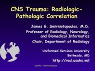 Subdural Hematoma - Radiology