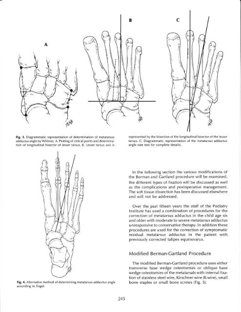 metatarsat osteotomy for the correction of metatarsus adductus
