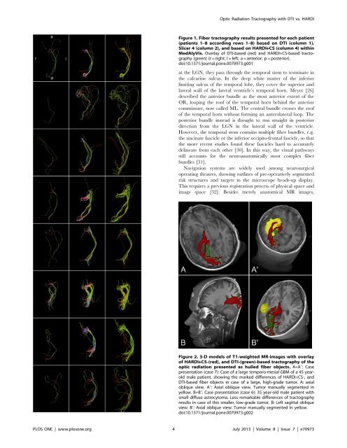 Optic Radiation Fiber Tractography in Glioma Patients ... - 3D Slicer