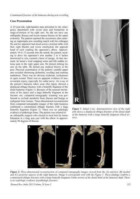 Comminuted fracture with butterfly fragment of the humerus ...