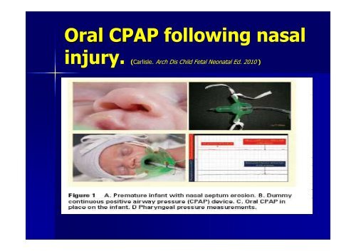 invasive respiratory support