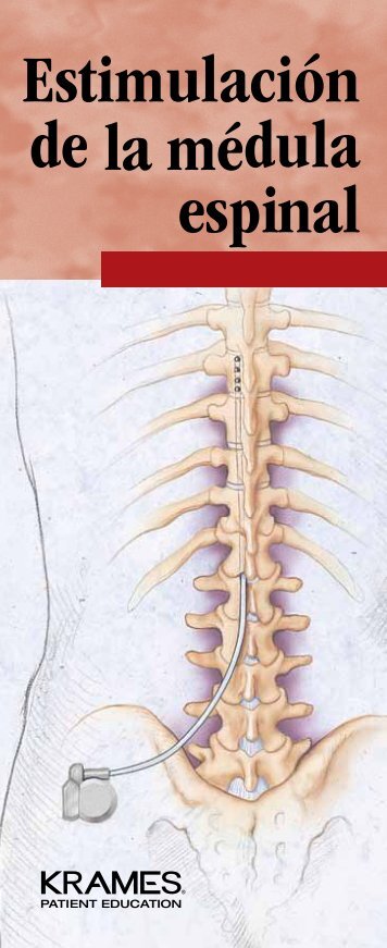 Estimulación de la médula espinal - Veterans Health Library