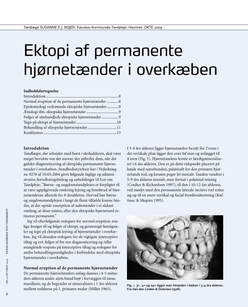 DKTE -rapport: Ektopi af permanente hjÃ¸rnetÃ¦nder i overkÃ¦ben