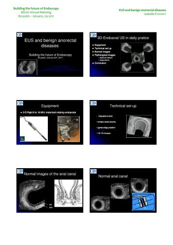 EUS and benign anorectal diseases