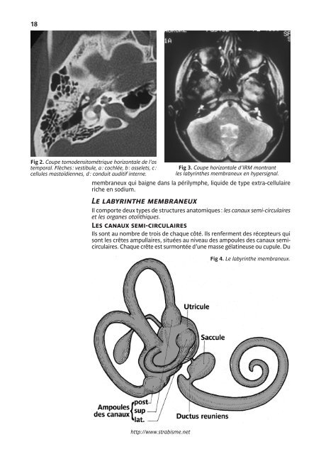 LE TORTICOLIS - Strabisme