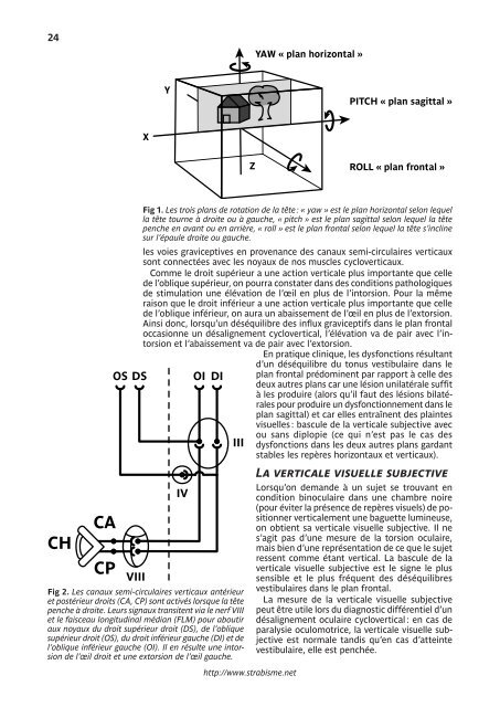 LE TORTICOLIS - Strabisme