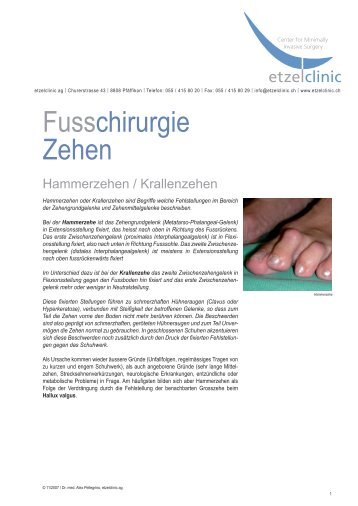 Fusschirurgie Zehen - Etzelclinic