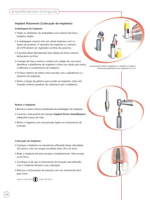 NOBELREPLACE - Nobel Biocare