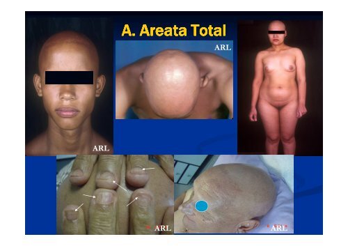 Alopecia areata derm Pediatrica - Antonio RondÃ³n Lugo