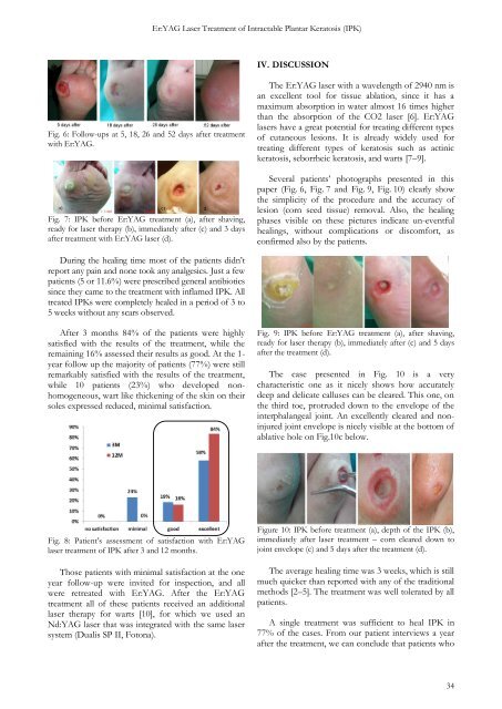 Er:YAG Laser Treatment of Intractable Plantar Keratosis (IPK)